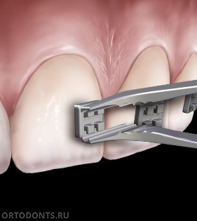 Фото статьи: Зачем ортодонт переклеивает брекеты во время лечения