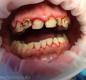 Фото публикации: Вред длительного ортодонтического лечения