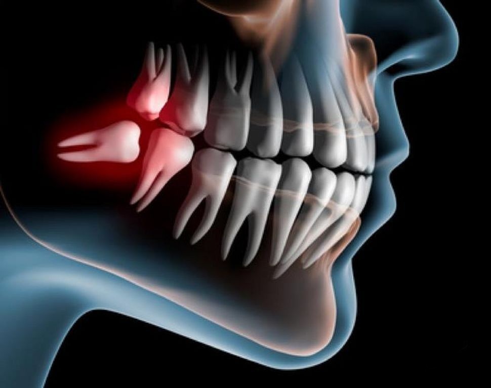 Удаление восьмых зубов ортодонт николаева