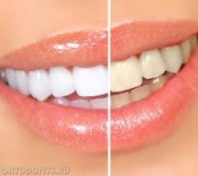 Фото статьи: Отбеливание зубов, возможные побочные эффекты