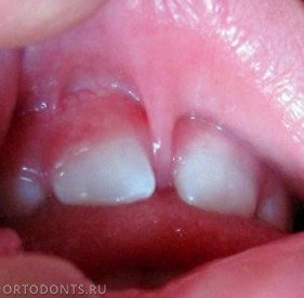Фото статьи: Уздечка верхней губы. Френулопластика- операция, пластика на уздечке верхней губы