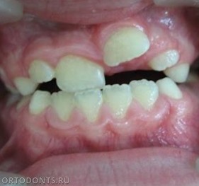 Фото статьи: Патологии зубов и прикуса (аномалии зубов и прикуса)