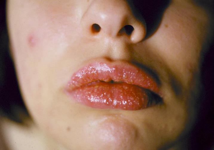 Аллергия на брекет-систему