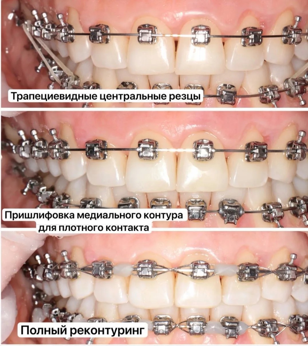 Контурирование зубов